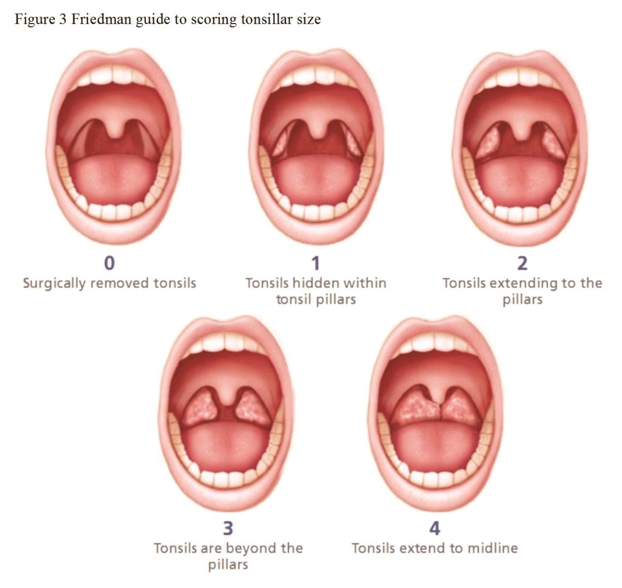 Current strategies for adenotonsillar infection, hyperplasia